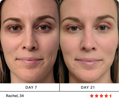 terapia de luz roja antes y después de las arrugas.