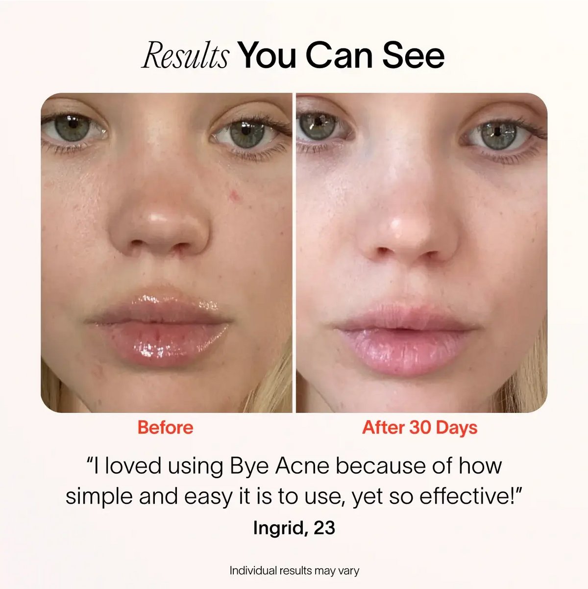 Close-up of a womans face before and after 30 days using SolaWaves Bye Acne: 3-Minute Pimple Spot Treatment shows improved complexion. Ingrid, 23, praises its simplicity and effectiveness with Red Light Therapies.|| Charcoal
