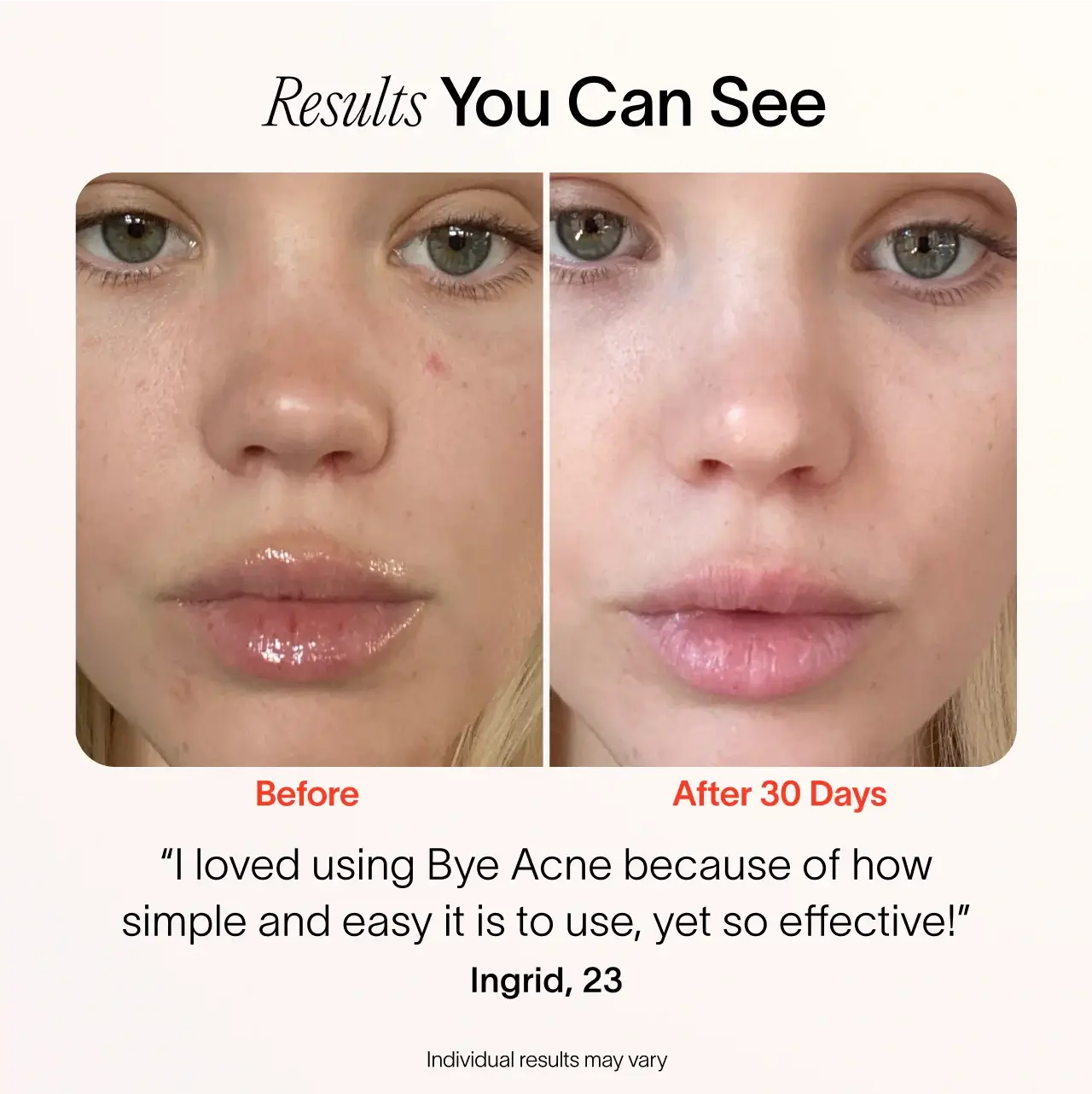 Close-up of a womans face before and after 30 days using SolaWaves Bye Acne: 3-Minute Pimple Spot Treatment shows improved complexion. Ingrid, 23, praises its simplicity and effectiveness with Red Light Therapies.|| Charcoal