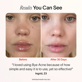 Close-up of a womans face before and after 30 days using SolaWaves Bye Acne: 3-Minute Pimple Spot Treatment shows improved complexion. Ingrid, 23, praises its simplicity and effectiveness with Red Light Therapies.|| Charcoal