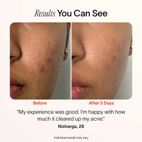 A close-up of a cheek shows breakouts before and a clearer complexion after five days using Bye Acne: 3-Minute Pimple Spot Treatment by SolaWave. A testimonial underneath praises the improved results aided by Blue Light Therapies. || Charcoal