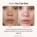 A close-up of a womans face depicts the before and after effects of SolaWaves Bye Acne: 3-Minute Pimple Spot Treatment. The left image shows breakouts, while the right reveals a clearer complexion. Caption reads: I loved using Bye Acne. before-after Ingrid, 23.  || Periwinkle