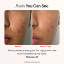 Split image shows a persons cheek before and after treatment. The Before side has visible breakouts, while the After 5 Days side shows clearer skin. Text: I’m happy with my experience using SolaWaves Bye Acne: 3-Minute Pimple Spot Treatment; it significantly cleared up my acne. before-after || Periwinkle