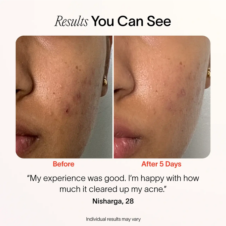 Split image shows a persons cheek before and after treatment. The Before side has visible breakouts, while the After 5 Days side shows clearer skin. Text: I’m happy with my experience using SolaWaves Bye Acne: 3-Minute Pimple Spot Treatment; it significantly cleared up my acne. || Periwinkle