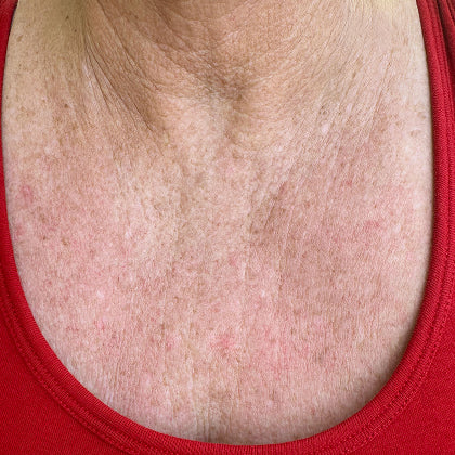 Red Light Therapy & Infrared Neck & Chest LED Skincare Mask