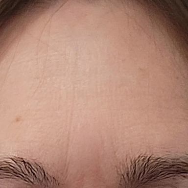 Forehead on day 30