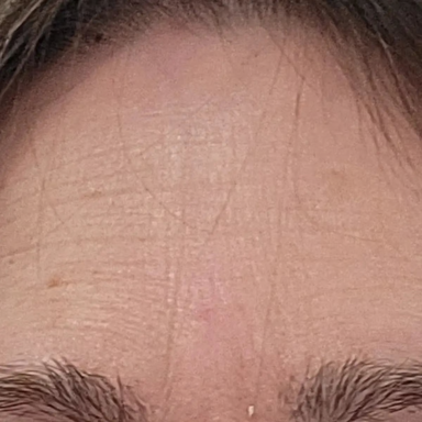 Forehead on day 1